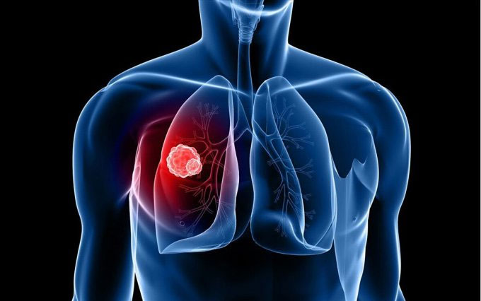 Tarlatamab-dlle: Liệu pháp mới cho bệnh ung thư phổi